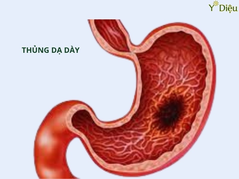 Có nhiều yếu tố dẫn tới thủng dạ dày như viêm loét và hoại tử